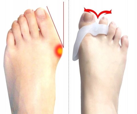 Osłona na haluksy silikonowa żelowy separator z klinem i osłoną 2szt. PID0541